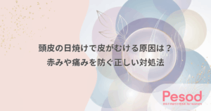 頭皮の日焼けで皮がむける原因は？赤みや痛みを防ぐ正しい対処法
