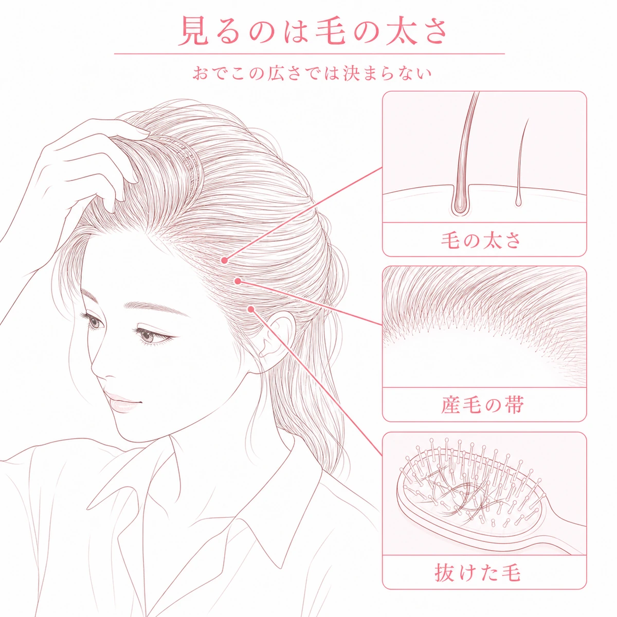 生え際の薄毛を毛の太さと産毛の帯と抜けた毛の3か所で見分ける方法を示した図解