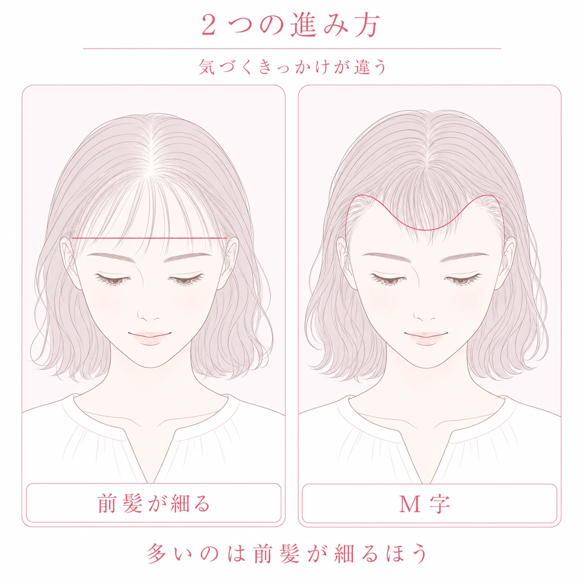 前髪全体が細くなる型と、こめかみの角が後ろへ退くM字型という女性の生え際の薄毛の2つの進み方を並べた図解