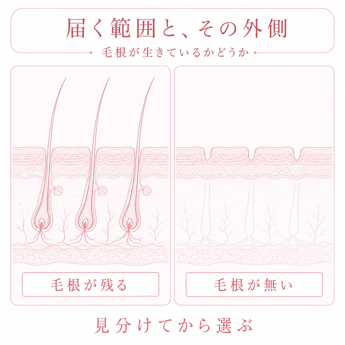 育毛剤が働きかけられる毛根の残る毛と範囲の外にある毛根を失った跡を上下に分けた図解